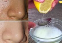 გამოიყენეთ ეს 2 ინგრედიენტი და თქვენი ფორები სამუდამოდ გაქრება და თქვენი სახე უფრო სუფთა გახდება, ვიდრე ოდესმე!