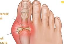 აი როგორ უნდა ამოიღოთ შარდმჟავას კრისტალები ორგანიზმიდან პოდაგრის თავიდან ასაცილებლად!