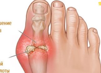 აი როგორ უნდა ამოიღოთ შარდმჟავას კრისტალები ორგანიზმიდან პოდაგრის თავიდან ასაცილებლად!