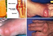 ეს არის საუკეთესო საშუალება, რაც კი ოდესმე შემხვედრია! ხალხური ძლიერი საშუალება პოდაგრისგან სამუდამოდ გაგათავისუფლებთ!