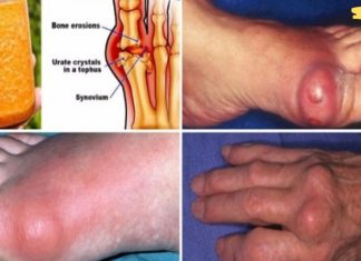 ეს არის საუკეთესო საშუალება, რაც კი ოდესმე შემხვედრია! ხალხური ძლიერი საშუალება პოდაგრისგან სამუდამოდ გაგათავისუფლებთ!