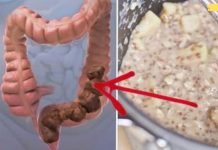 ეს ნარევი გაწმენდს თქვენს მსხვილ ნაწლავს! მე თვითონ ვცადე და შედეგი საოცარია!