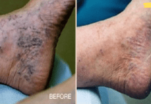 ყველაზე ეფექტური საშუალება ვარიკოზული ვენებისა და ბუასილისთვის! მნიშვნელოვან შედეგს შეამჩნევთ 7 დღის შემდეგ!