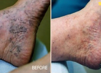 ყველაზე ეფექტური საშუალება ვარიკოზული ვენებისა და ბუასილისთვის! მნიშვნელოვან შედეგს შეამჩნევთ 7 დღის შემდეგ!
