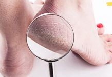 დროა ერთხელ და სამუდამოდ უმკურნალოთ გაბზარულ ქუსლებს! შენი ფეხები იმსახურებს ამას!