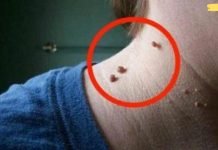 ყველას აქვს, მაგრამ არავინ იცის როგორ მოიშოროს ისინი! ფიბროიდების ეს ხრიკი საოცრებას ახდენს!