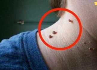 ყველას აქვს, მაგრამ არავინ იცის როგორ მოიშოროს ისინი! ფიბროიდების ეს ხრიკი საოცრებას ახდენს!