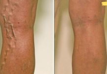 ნაპოვნია ვარიკოზული ვენების სამკურნალო ბუნებრივი საშუალება! შედეგი სასიამოვნოდ გაგაოცებთ!