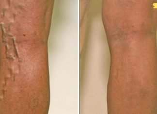 ნაპოვნია ვარიკოზული ვენების სამკურნალო ბუნებრივი საშუალება! შედეგი სასიამოვნოდ გაგაოცებთ!