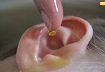 როგორ მოვიშოროთ ყურის ტკივილი 1 წუთში. წვეთები, რომლებიც ნამდვილად ეხმარება!