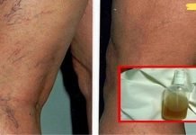 ბუნებრივი ინგრედიენტებისგან დამზადებული ეს ბალზამი საუკეთესო საშუალებაა სისხლძარღვთა ქსელის მოსაშორებლად და კანის სილამაზის აღსადგენად!