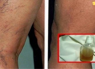 ბუნებრივი ინგრედიენტებისგან დამზადებული ეს ბალზამი საუკეთესო საშუალებაა სისხლძარღვთა ქსელის მოსაშორებლად და კანის სილამაზის აღსადგენად!