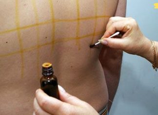 იოდის ბადე: მარტივი ხაზების სამკურნალო თვისებები. ძალიან სასარგებლოა!