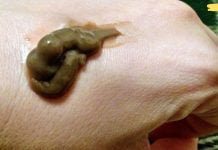 დავიწყებული ვიშნევსკის მალამო შეუცვლელია ნაოჭებთან და ასაკობრივ ლაქებთან ბრძოლაში