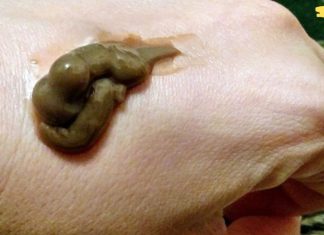 დავიწყებული ვიშნევსკის მალამო შეუცვლელია ნაოჭებთან და ასაკობრივ ლაქებთან ბრძოლაში