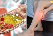 გაიწმინდეთ დახშული არტერიები და მოიშორეთ ცუდი ქოლესტერინი ამ ბუნებრივი საშუალების დახმარებით