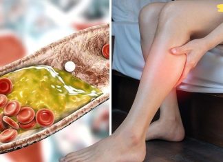 გაიწმინდეთ დახშული არტერიები და მოიშორეთ ცუდი ქოლესტერინი ამ ბუნებრივი საშუალების დახმარებით