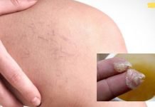 3 მცენარეული საშუალება ვარიკოზული ვენებისა და როზაცეას სამკურნალოდ!! აუცილებლად მივმართავ ამ ხერხს..