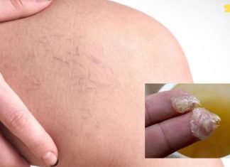 3 მცენარეული საშუალება ვარიკოზული ვენებისა და როზაცეას სამკურნალოდ!! აუცილებლად მივმართავ ამ ხერხს..