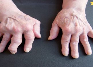 ამ ქალმა რევმატიზმი თავისით განკურნა! აი რა გააკეთა მან! საიდუმლო რეცეპტი სტატიაშია!