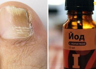 ეს არის ის, რაც დამეხმარა ამ საშინელი ფრჩხილის სოკოსგან თავის დაღწევაში! საჭიროა მხოლოდ 3 მკურნალობა!