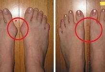 ამის თავიდან ასაცილებლად, აღარ გჭირდებათ ქირურგის დახმარება! ყველაფერის მოგვარება მარტივად შეგიძლიათ!