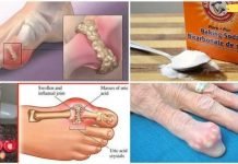 როგორ სწრაფად ამოიღოთ შარდმჟავას კრისტალები ორგანიზმიდან პოდაგრის თავიდან ასაცილებლად!