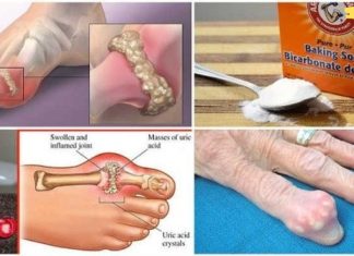 როგორ სწრაფად ამოიღოთ შარდმჟავას კრისტალები ორგანიზმიდან პოდაგრის თავიდან ასაცილებლად!