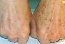 მარტივი გზა კანზე ყავისფერი ლაქების მოსაშორებლად! რეცეპტი იხილეთ სტატიაში!