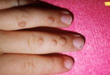 აი როგორ მოვიშოროთ მეჭეჭები და პაპილომები წყალბადის ზეჟანგით! თავად სცადე!