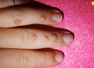 აი როგორ მოვიშოროთ მეჭეჭები და პაპილომები წყალბადის ზეჟანგით! თავად სცადე!