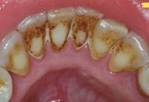 აი როგორ უნდა მოვიშოროთ ნადები სტომატოლოგთან ვიზიტის გარეშე! მეორე მეთოდი მშველის ყოველ ჯერზე!