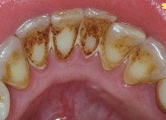 აი როგორ უნდა მოვიშოროთ ნადები სტომატოლოგთან ვიზიტის გარეშე! მეორე მეთოდი მშველის ყოველ ჯერზე!