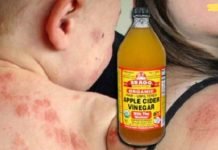 აი, როგორ გამოვიყენოთ ვაშლის ძმარი ეგზემის სამკურნალოდ, ეს წარმოუდგენლად ეფექტური მეთოდია!