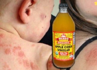 აი, როგორ გამოვიყენოთ ვაშლის ძმარი ეგზემის სამკურნალოდ, ეს წარმოუდგენლად ეფექტური მეთოდია!