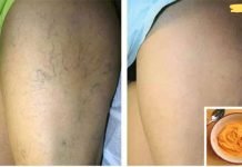 ყველაზე ეფექტური ხალხური საშუალება ვარიკოზული ვენებისთვის! გამოიყენეთ და მადლობელი იქნებით!