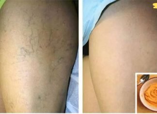 ყველაზე ეფექტური ხალხური საშუალება ვარიკოზული ვენებისთვის! გამოიყენეთ და მადლობელი იქნებით!