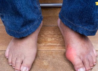 როგორ ეფექტურად ავიცილოთ თავიდან პოდაგრა და სახსრების ტკივილი ორგანიზმიდან კრისტალიზებული შარდმჟავას მოცილებით!