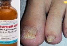 სამი რეცეპტი ფრჩხილებზე სოკოს სამკურნალოდ!! დადასტურებული მეთოდები!!.