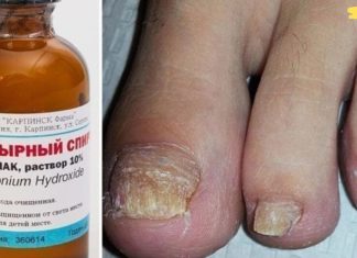 სამი რეცეპტი ფრჩხილებზე სოკოს სამკურნალოდ!! დადასტურებული მეთოდები!!.