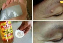 მოიცილეთ მეჭეჭები, მუქი ლაქები, შავი წერტილები და პაპილომები სწრაფად და ეფექტურად ამ ხალხური საშუალების დახმარებით!