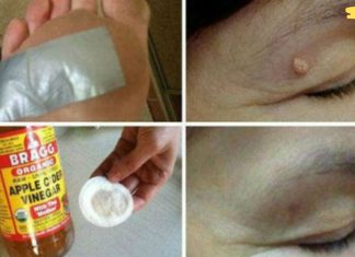 მოიცილეთ მეჭეჭები, მუქი ლაქები, შავი წერტილები და პაპილომები სწრაფად და ეფექტურად ამ ხალხური საშუალების დახმარებით!