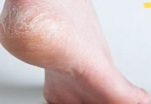 დაბზარული ქუსლების მკურნალობა და ფეხებზე კანის მოვლის მარტივი წესები