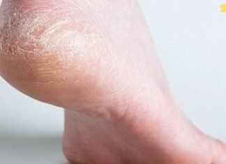დაბზარული ქუსლების მკურნალობა და ფეხებზე კანის მოვლის მარტივი წესები