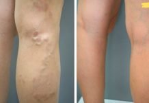 სანამ გვიანი არ არის გამოიყენეთ ეს ხელით დამზადებული ნარევი ვარიკოზული ვენების სამკურნალოდ! უკვე აღარ მეგონა ჩემს ვენებს რამე თუ უშველიდა! ამ ნარევმა სასწაული მოახდინა!