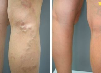 სანამ გვიანი არ არის გამოიყენეთ ეს ხელით დამზადებული ნარევი ვარიკოზული ვენების სამკურნალოდ! უკვე აღარ მეგონა ჩემს ვენებს რამე თუ უშველიდა! ამ ნარევმა სასწაული მოახდინა!