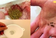 ამ ხალხური საშუალების გამოყენებით- თირკმელებიდან ყველა ქვას მოაცილებთ!!