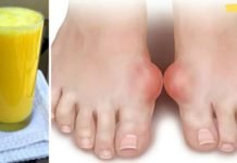 სამუდამოდ დაემშვიდობეთ პოდაგრას ამ ძლიერი ბუნებრივი მკურნალობით! ძალიან ეფექტურია!