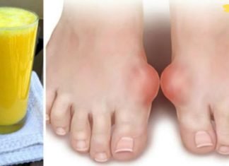 სამუდამოდ დაემშვიდობეთ პოდაგრას ამ ძლიერი ბუნებრივი მკურნალობით! ძალიან ეფექტურია!