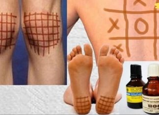 იოდის ბადე: მარტივი ხაზების სამკურნალო თვისებები! მისი ეფექტურობა დადასტურებულია!